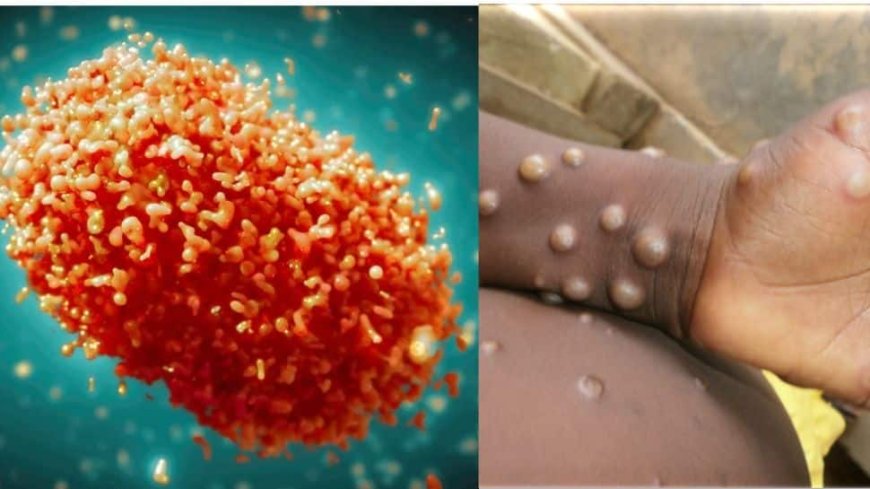 How Vulnerable Is India To Mpox? Know What Health Ministry`s Report Says